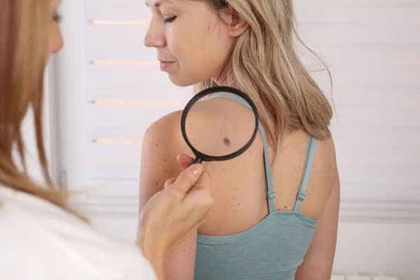 What Are Traditional Skin Lesion Removal Methods Stratford-upon-Avon?