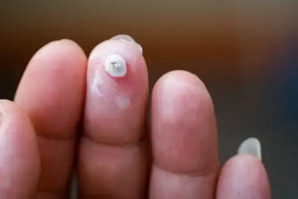 Image of white wart before cryopen treatment Stratford-upon-Avon
