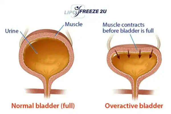 diagram of overactive bladder treatment Stratford-upon-Avon