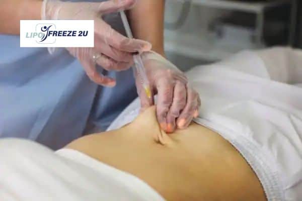 How Does Aqualyx Fat Dissolving Injection Work to Break Down Fat Stratford-upon-Avon?