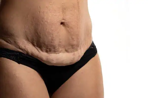 loose skin after weight loss injections Stratford-upon-Avon