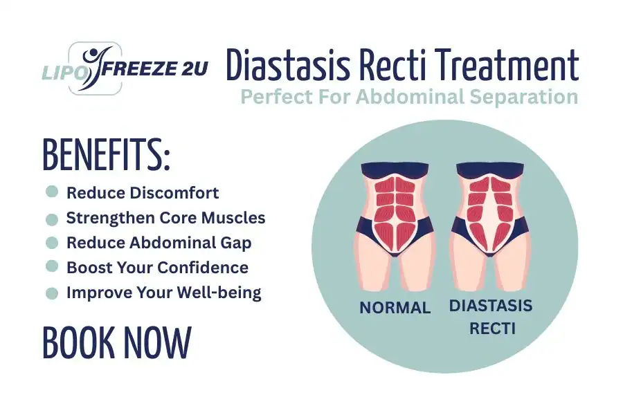 Benefits of body toning treatment Stratford-upon-Avon for Diastasis recti