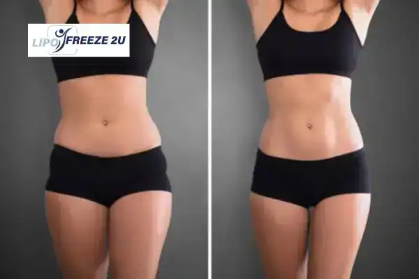 How Can LIPO FREEZE 2U Support Your Post-Pregnancy Body Recovery Stratford-upon-Avon?