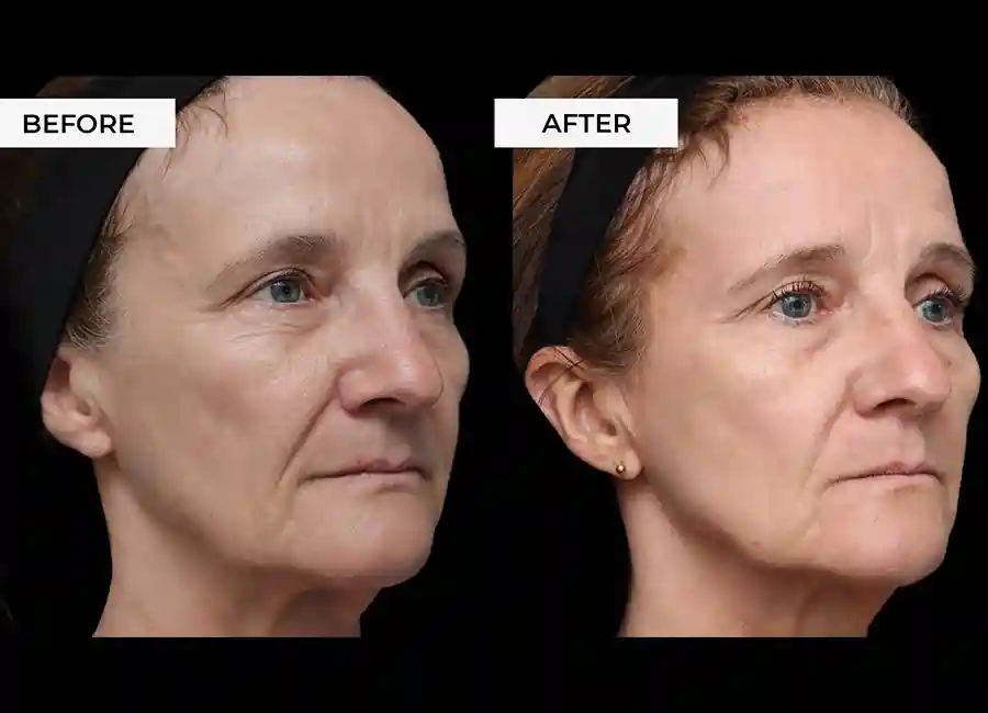 How Many RF Microneedling Sessions Will You Need to See a Difference Stratford-upon-Avon?