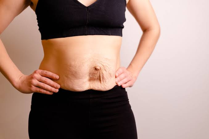 Is Surgery Really the Only Way to Repair Diastasis Recti Stratford-upon-Avon?