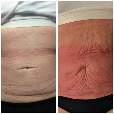 How Does RF Microneedling Improve Crepey, Thin and Uneven Skin Texture Stratford-upon-Avon?