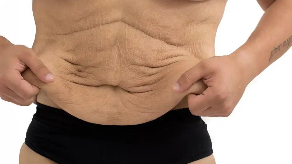 RF Microneedling for Loose Skin: How Can It Help Tighten and Reshape the Skin Stratford-upon-Avon?